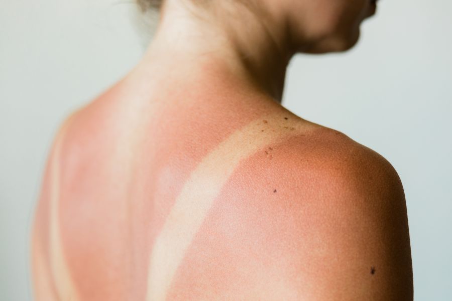 woman with sun burn lines